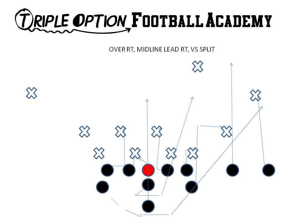OVER MIDLINE LEAD V SPLIT